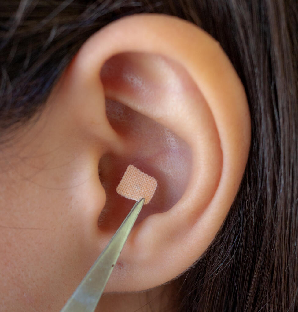 auriculoterapia