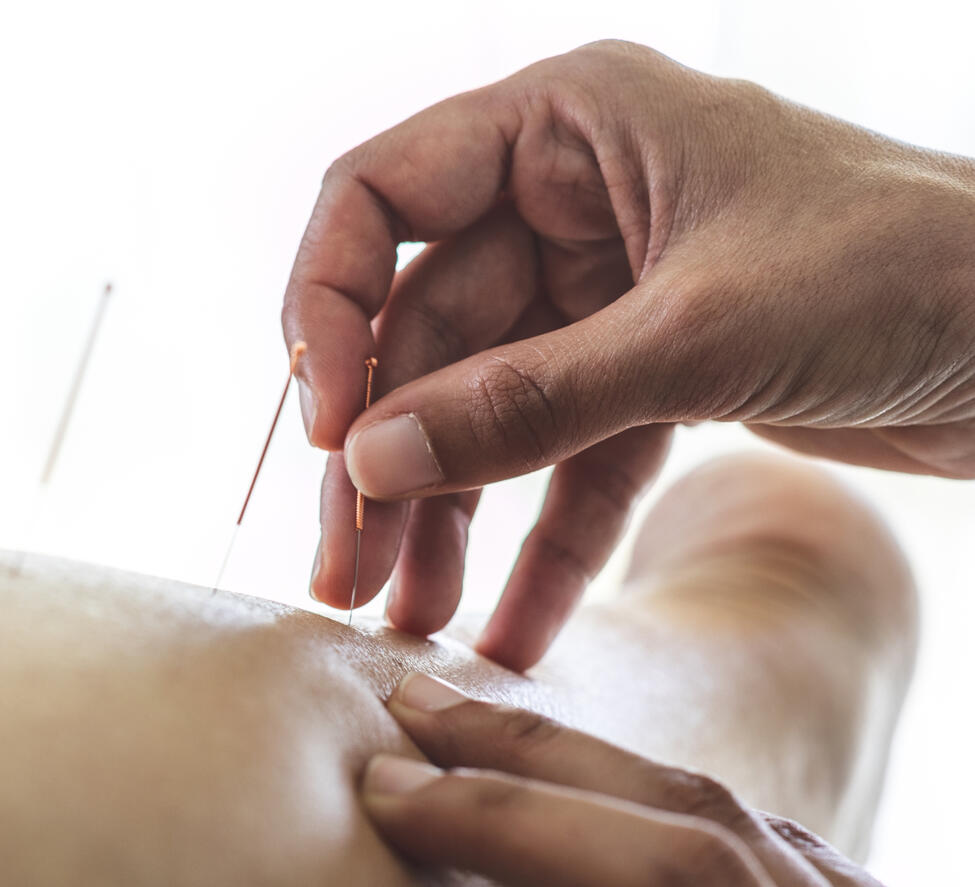 acupuntura acupuntura para dor
